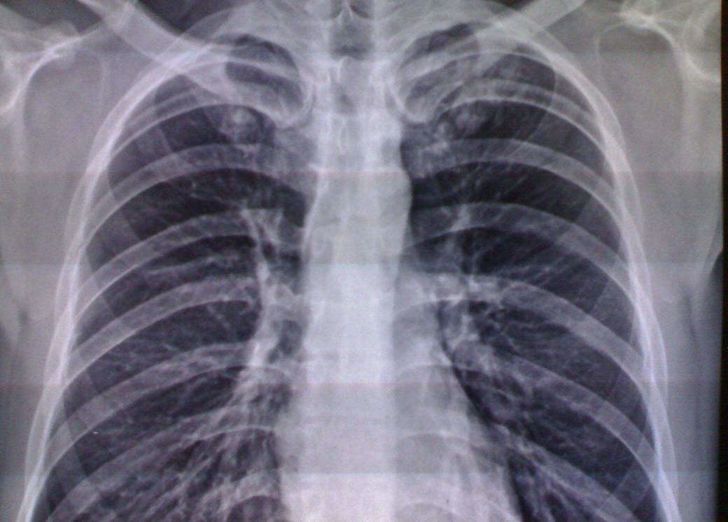 医学影像学呼吸系统复习重点